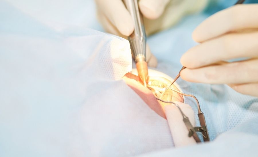 ICL手術の流れと所要時間