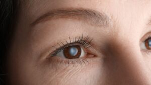 白内障を疑うべき症状一覧｜見逃しやすいサインと受診の目安