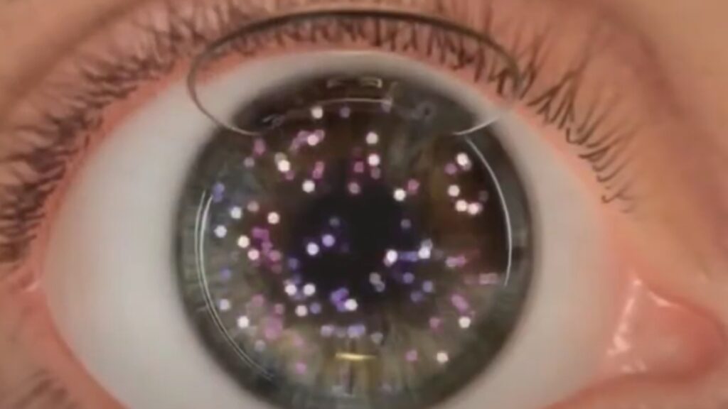 レーシック手術中は意識がある？痛みやまばたきは大丈夫？