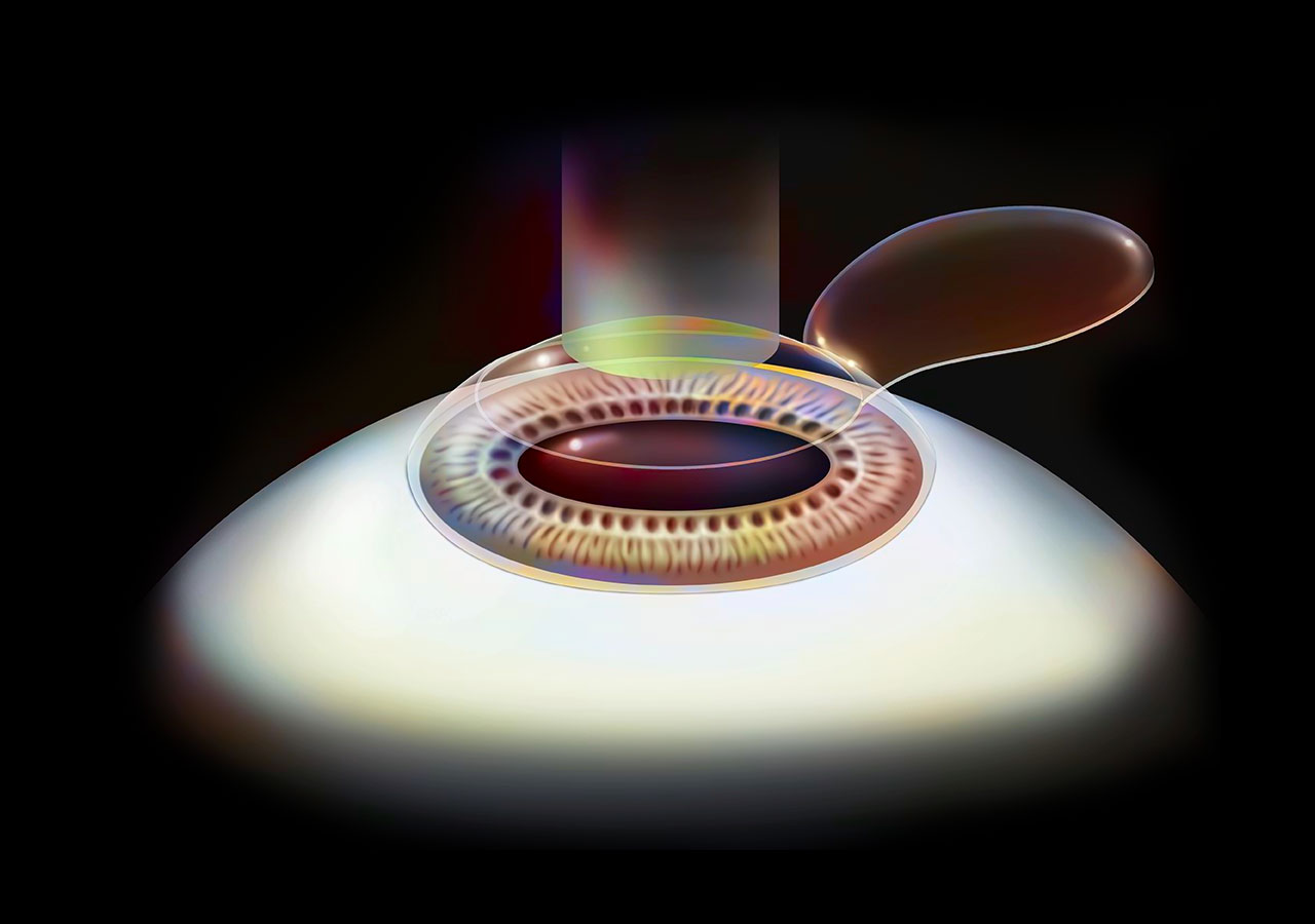 Contoura LASIK 手術機器